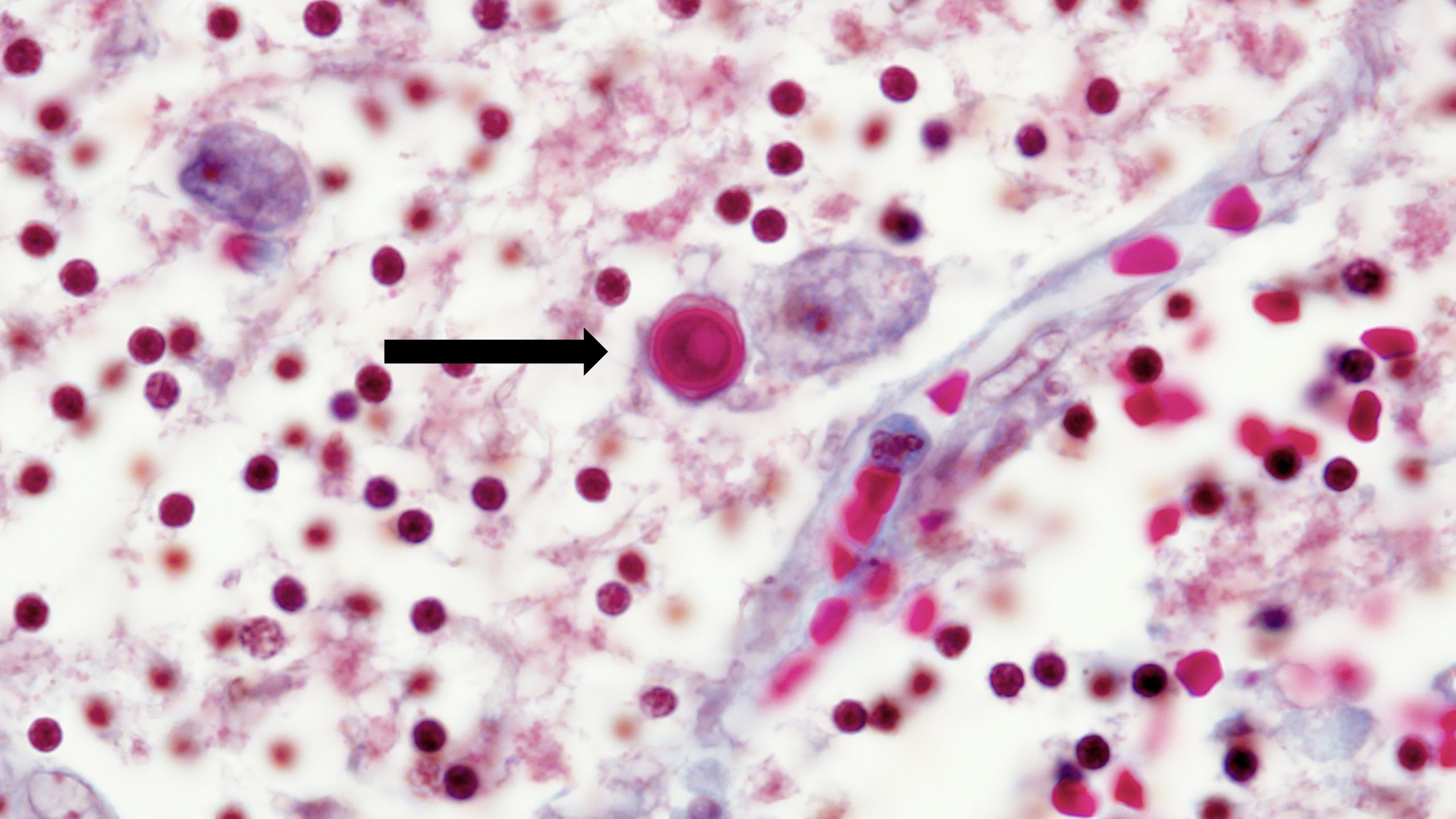 Acanthamoeba-Microscopic Image 1 High resolution of Acanthamoeba in a patient's brain