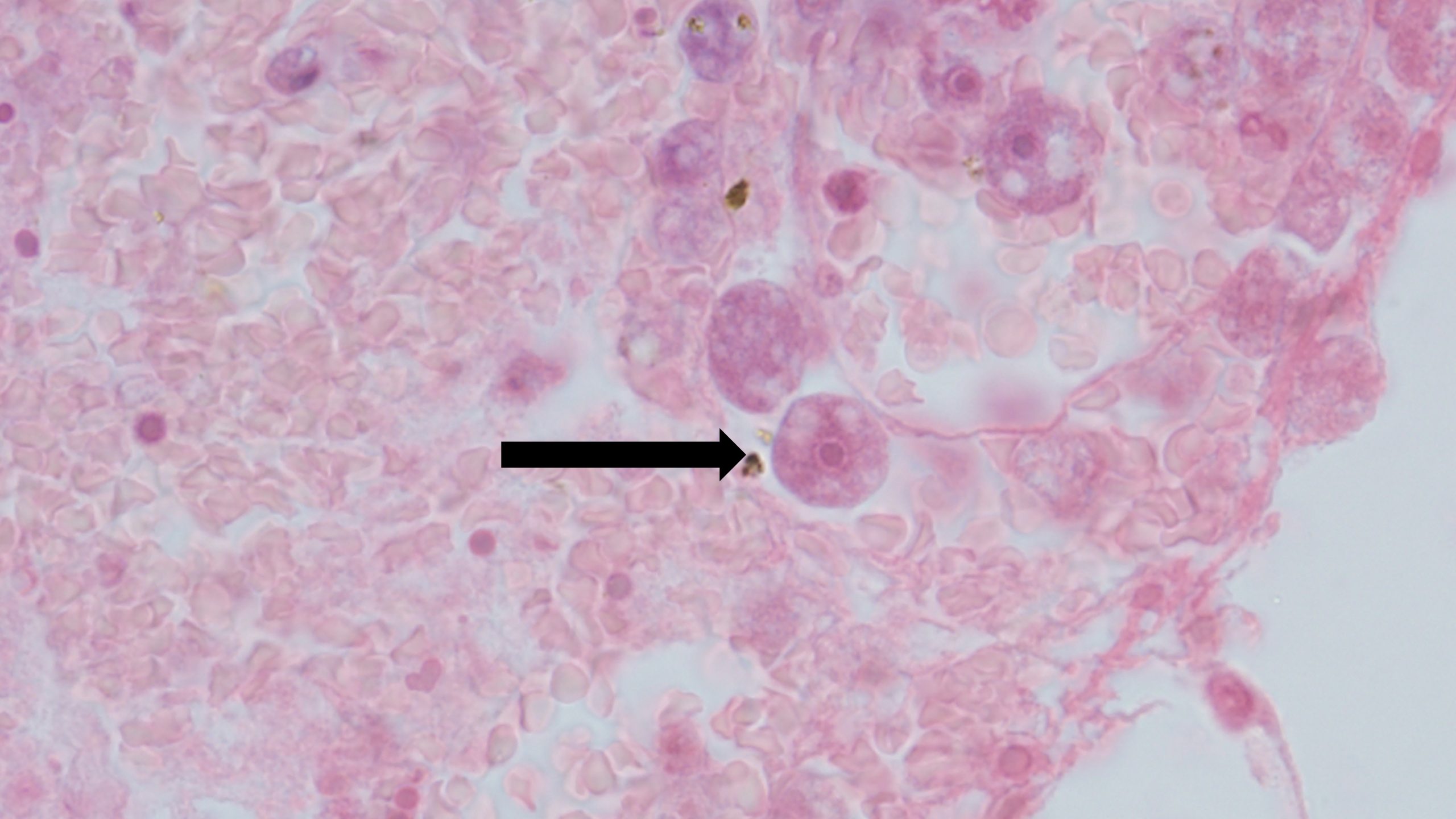 Acanthamoeba-Image 2 High resolution of Acanthamoeba in a patient's brain.