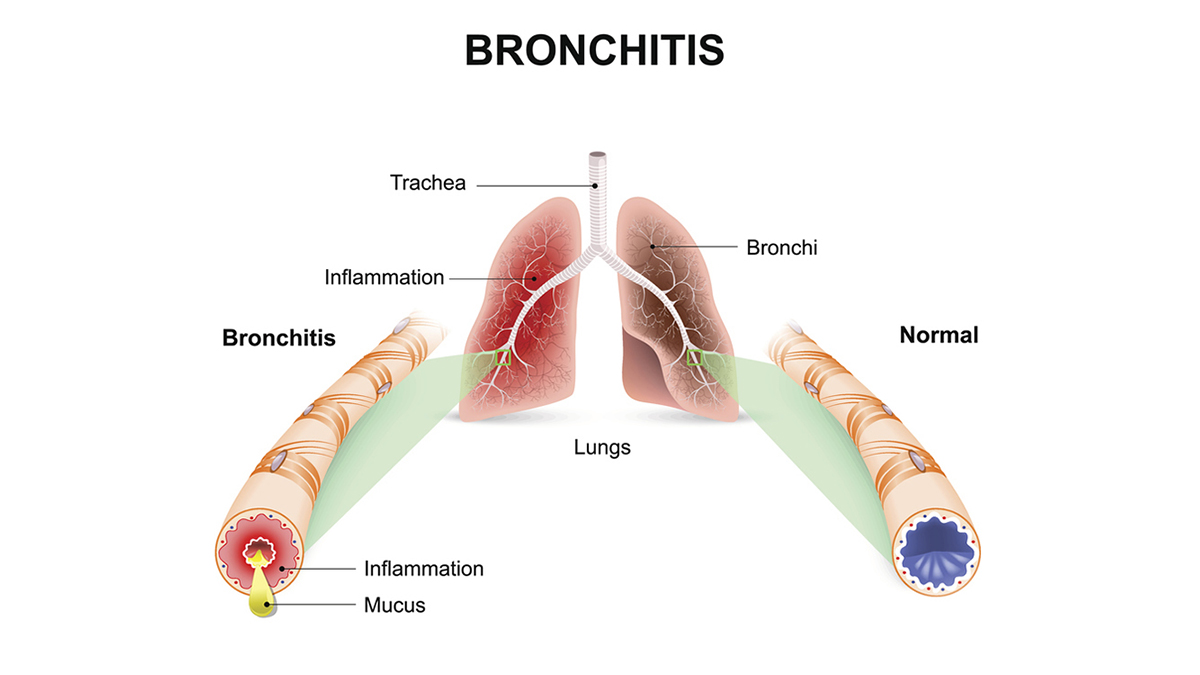 This image depicts the difference between a healthy lung air passage and an unhealthy lung air passage.