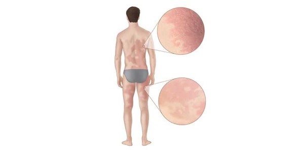 AlphagalAllergy600x300 Diagram of man’s body showing red rash all over