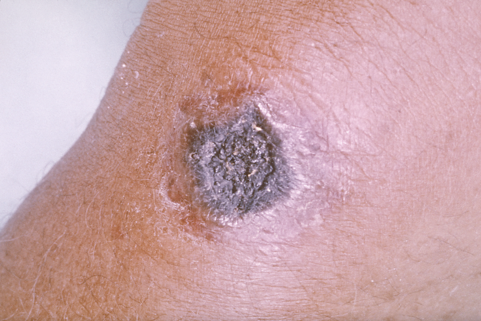 Black sores on an arm are a sign of cutaneous anthrax