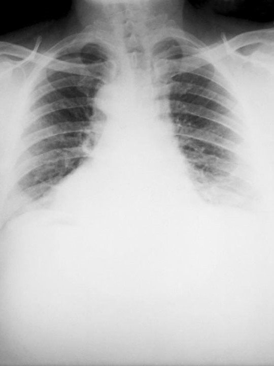 Chest x ray showing anthrax