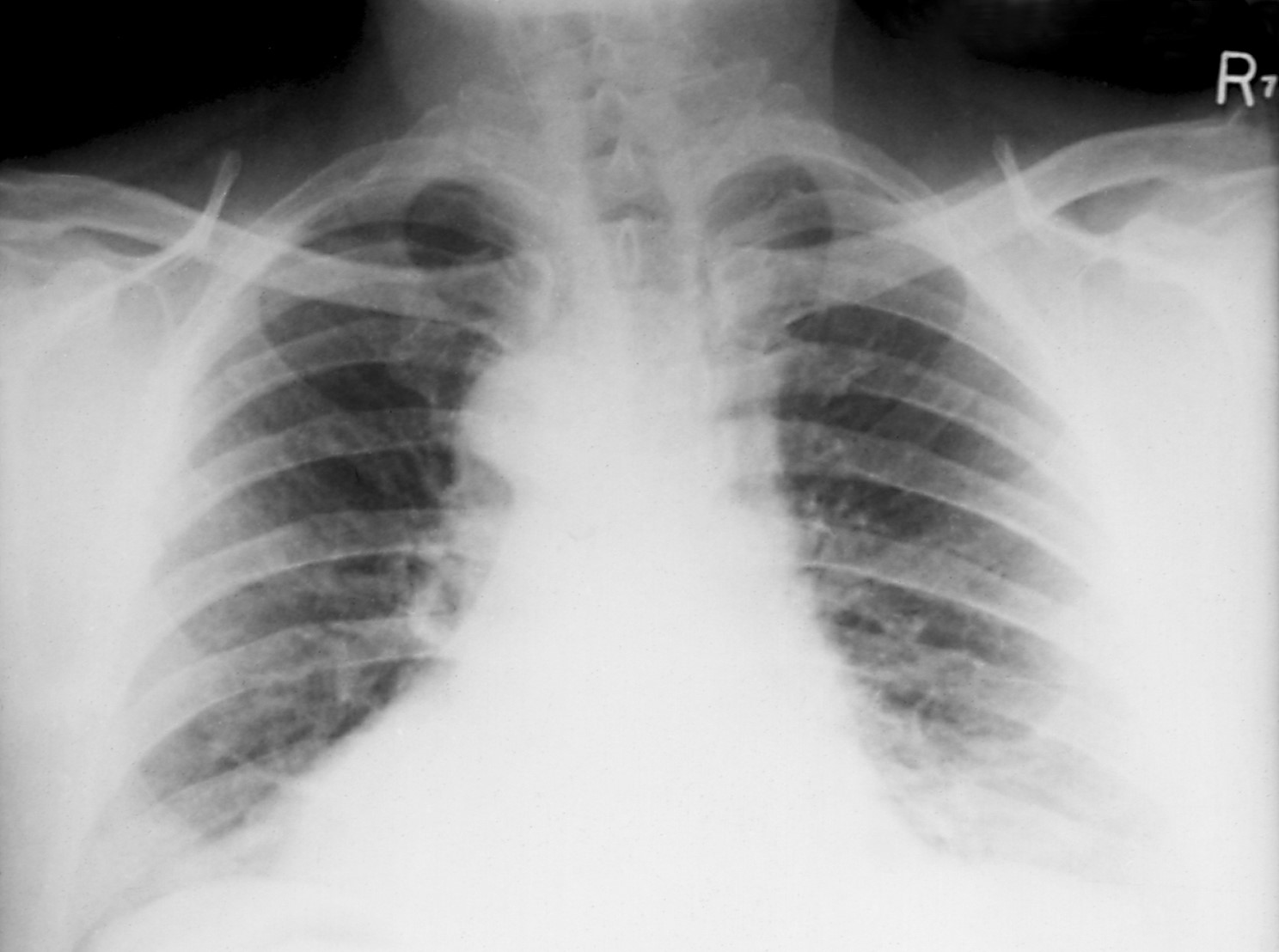 This x-ray of a patient with inhalation anthrax shows damage throughout the lungs