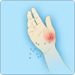 Shows anthrax spores getting into a cut on the skin, causing cutaneous anthrax