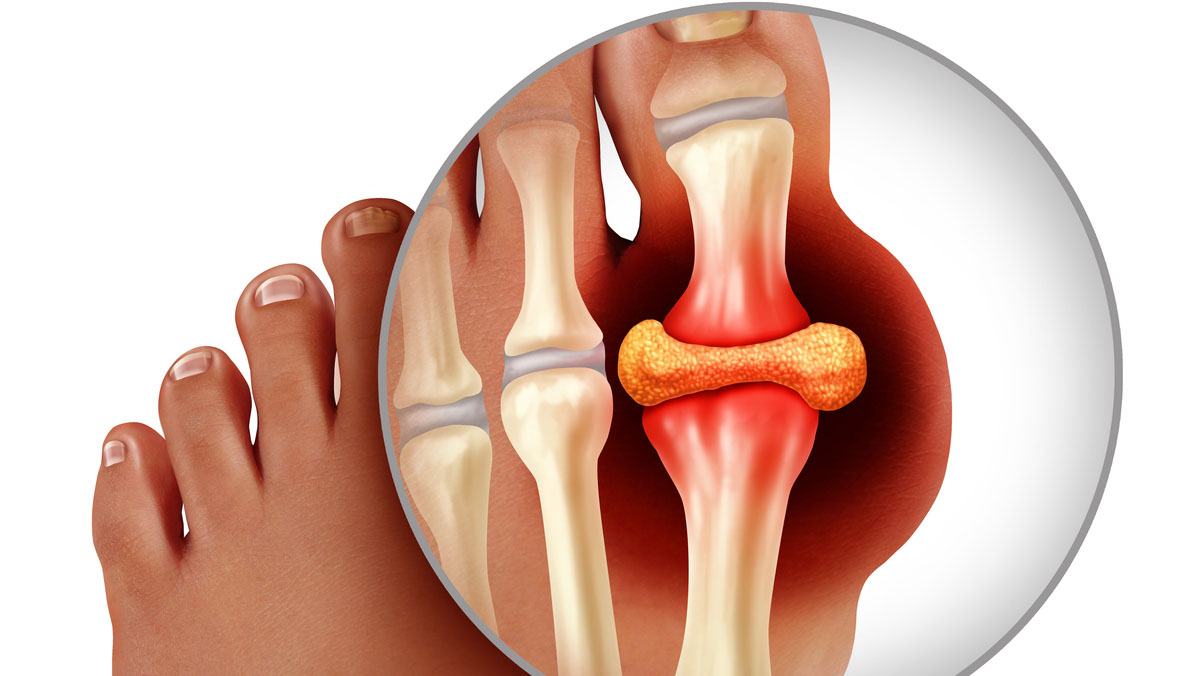 Illustration of the big toe showing swelling, redness, and pain Illustration of uric acid buildup in between two joints of the big toe showing swelling, redness, and pain