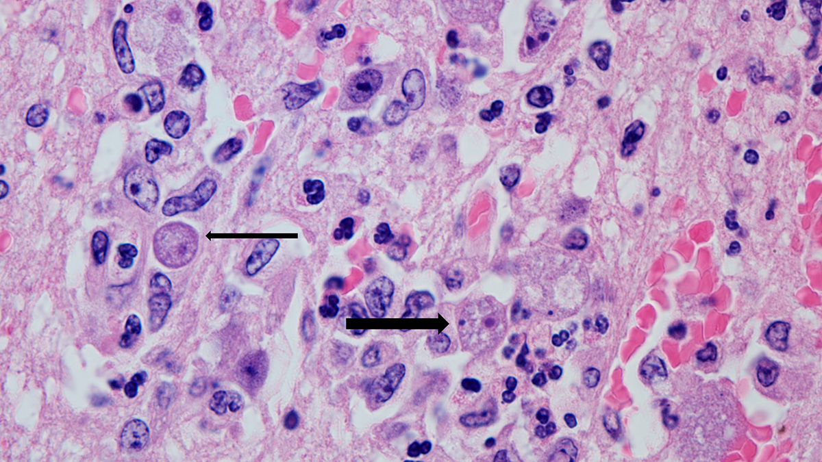 Balamuthia amebas in a person's brain Balamuthia amebas in a person's brain. A thick arrow points to the infectious form of the ameba. A thin arrow points to a developing cyst, the dormant, non-infectious form.