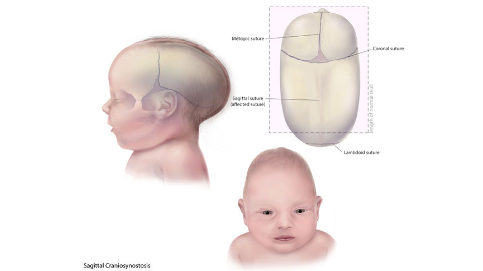 Illustration of infant with Sagittal Craniosynostosis Illustration of an infant with Sagittal Craniosynostosis.