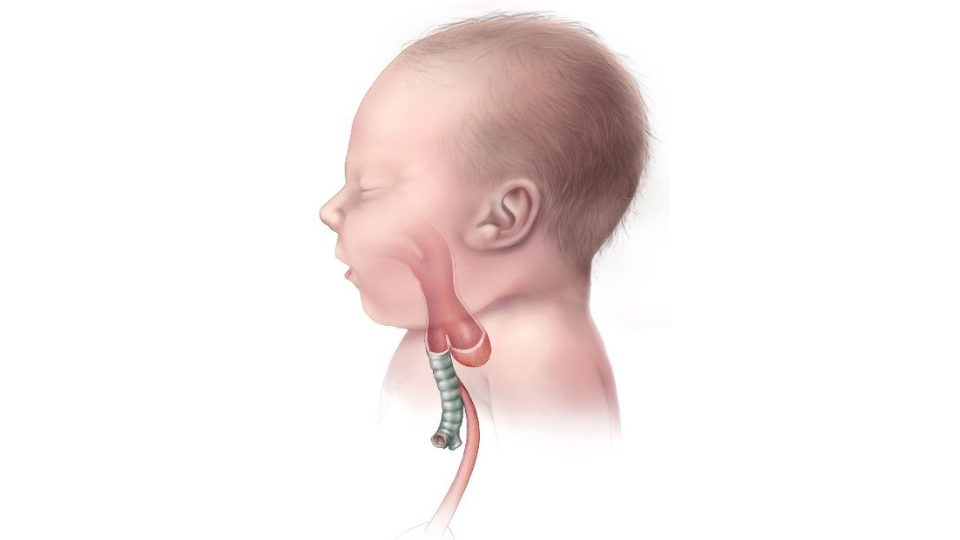 esophageal atresia Illustration of infant with esophageal atresia type C.