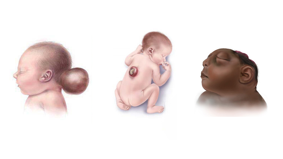 NTD collage Collage of illustrations of infants with encephalocele, spina bifida, and anencephaly
