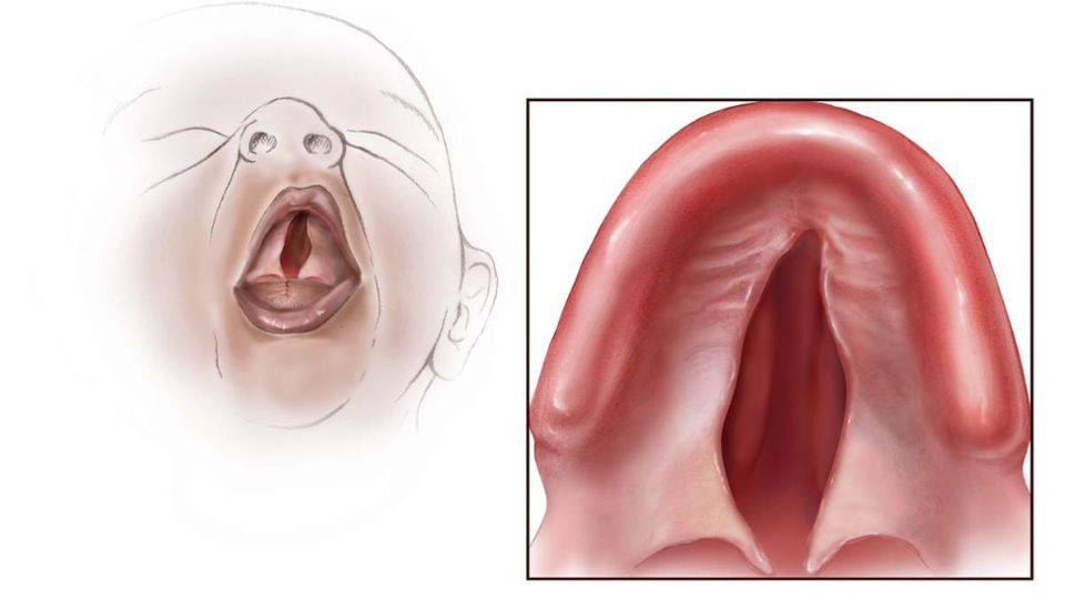 Cleft Palate Illustration of infant with cleft palate.