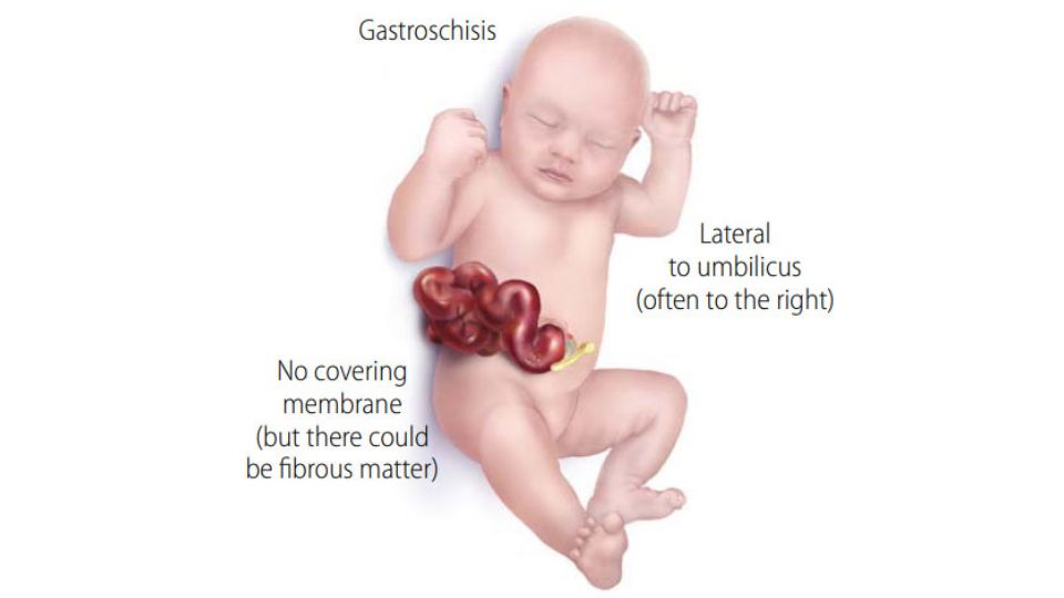 -- title missing -- Medical illustration of infant with gastroschisis.