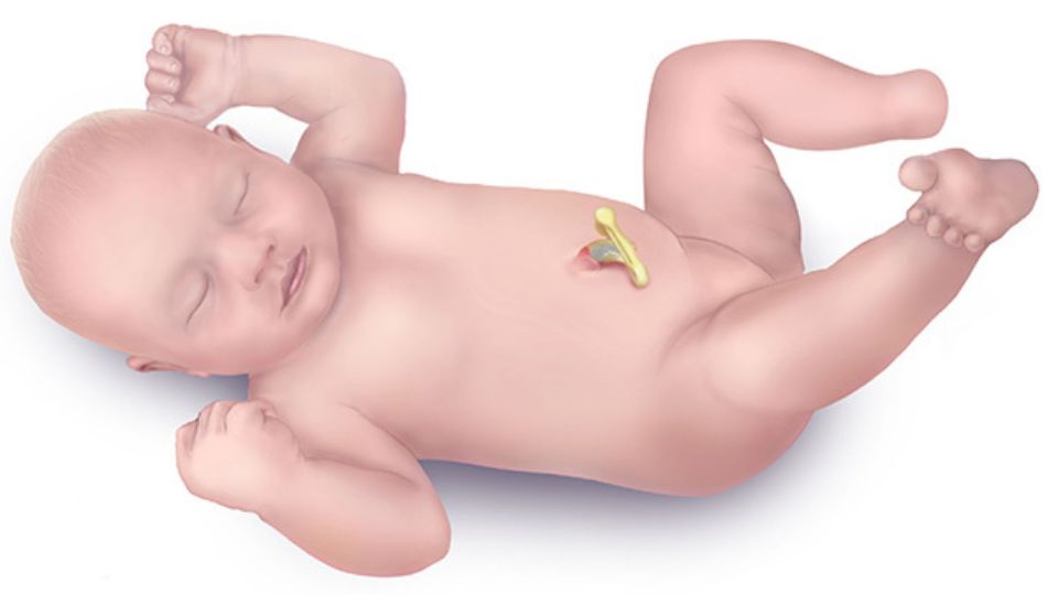Limb reduction defects Illustration of a newborn baby with a limb reduction