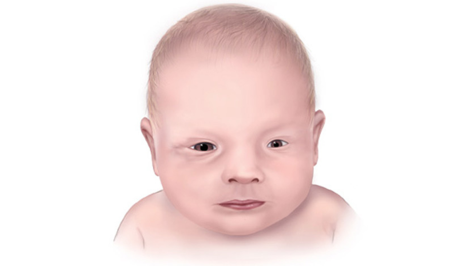 Microphthalmia Illustration of infant with microphthalmia, one small eye.