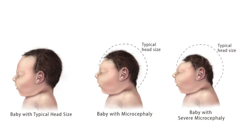 Severity of microcephaly Illustration of 3 babies showing range of microcephaly from mild to severe