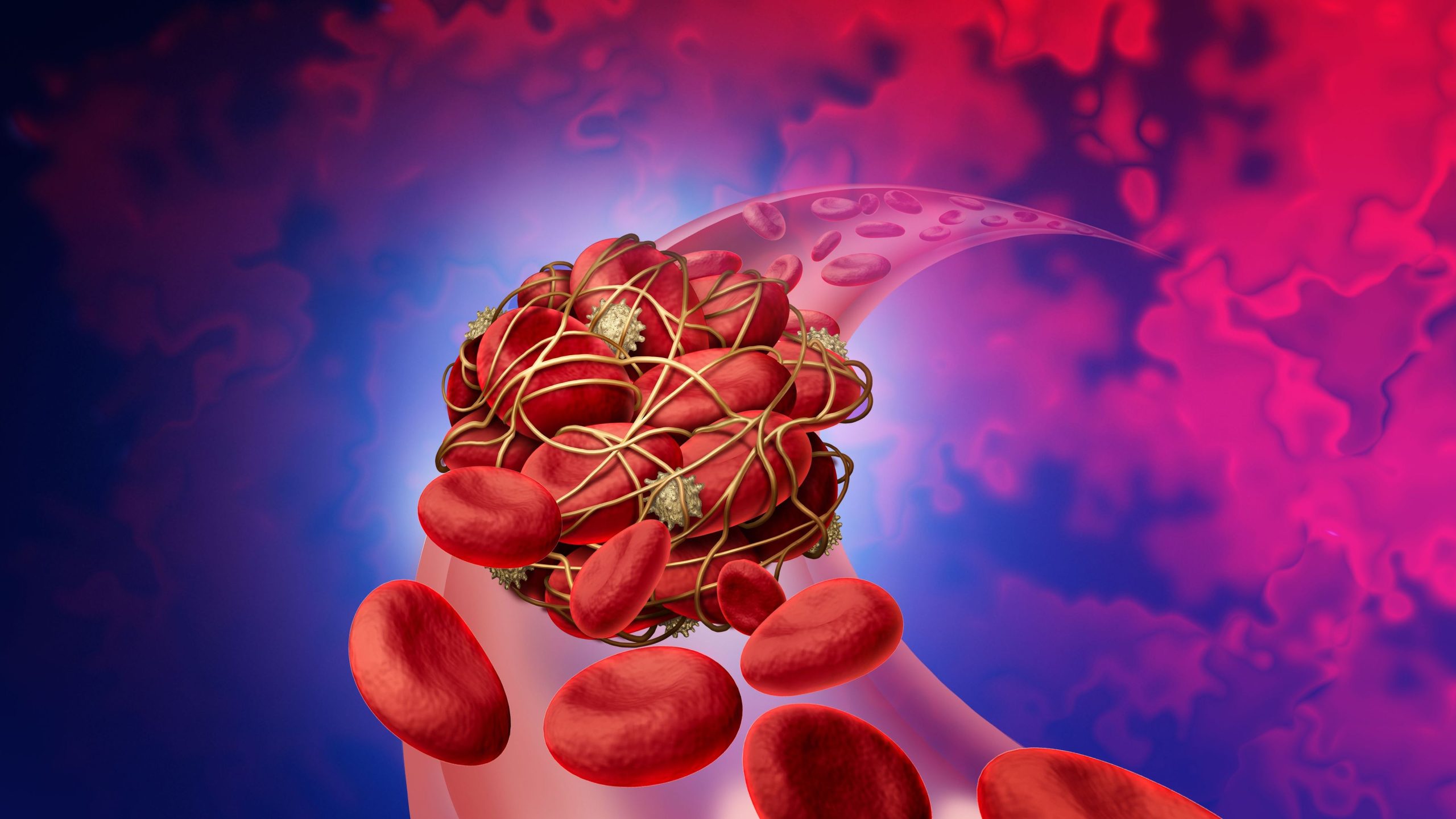 Blood Clot Horizontal Photo of blood clot in a vein