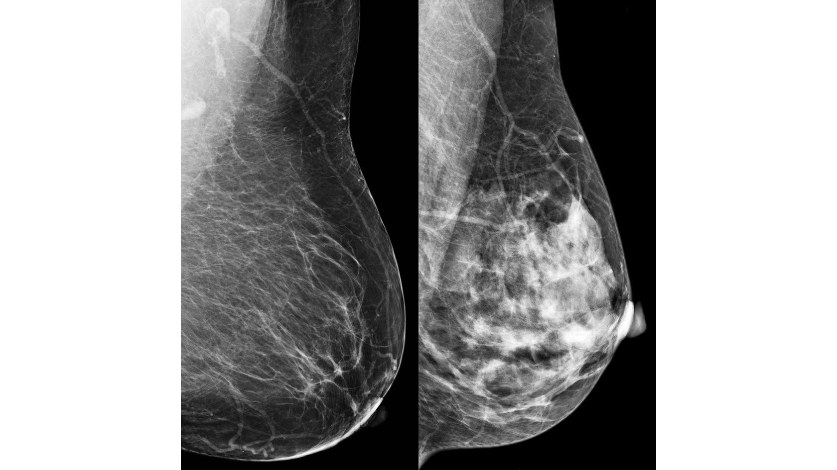 Two Mammograms Dos mamografías que muestran una mama grasa y una mama densa