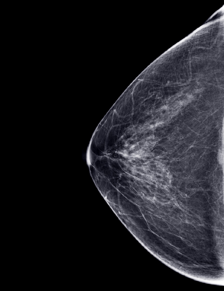 mammogram923x1200 a mammogram