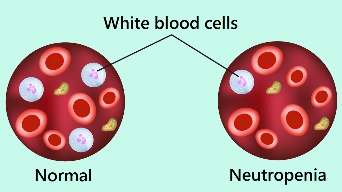 Neutropenia illustration Normal white blood cells and neutropenia