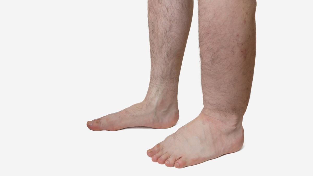 Lymphedema Photo of a person with lymphedema in the left leg