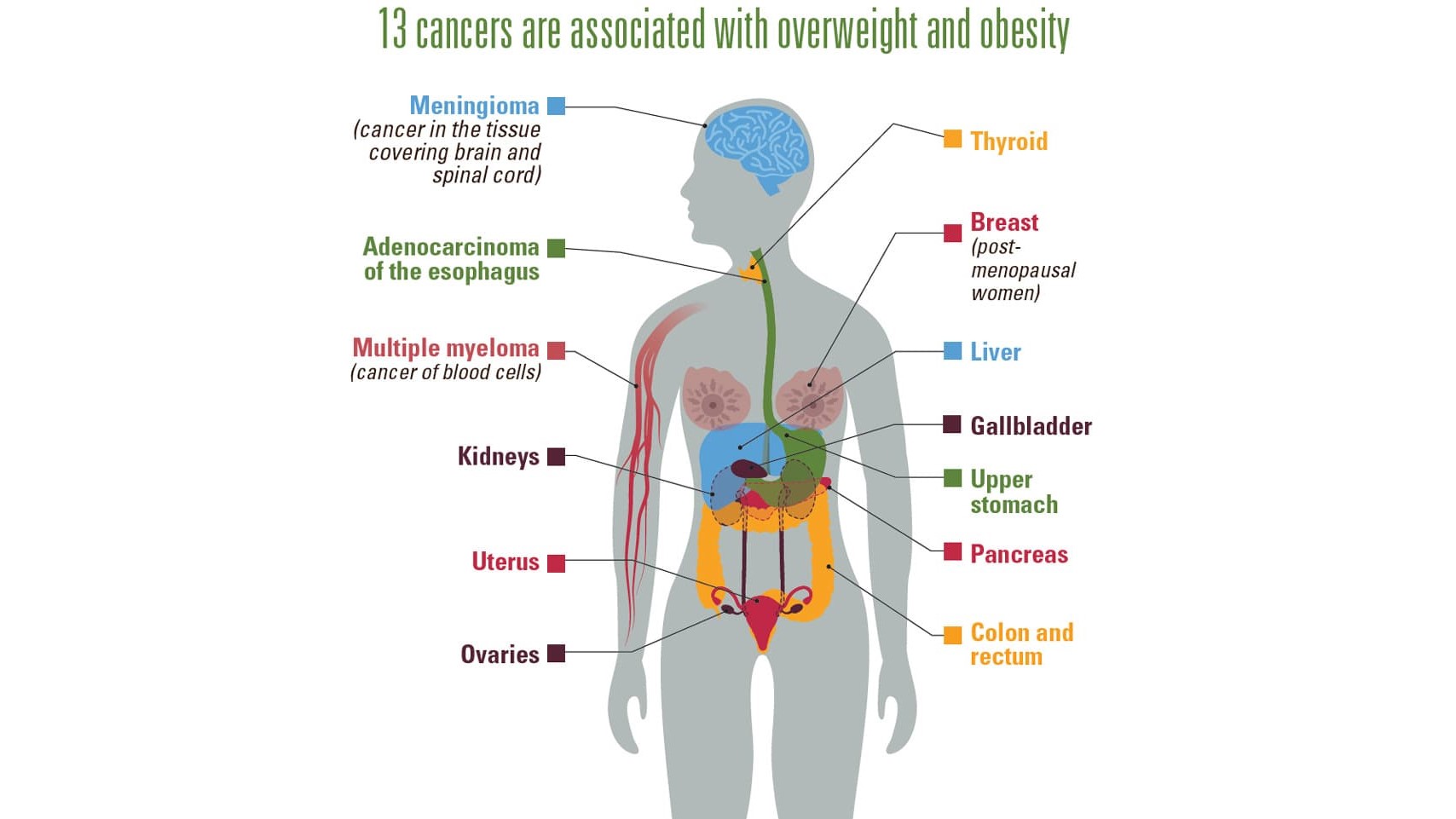 Obesity Cancer 13 cancers are associated with overweight and obesity: meningioma (cancer in the tissue covering brain and spinal cord); adenocarcinoma of the esophagus; multiple myeloma (cancer of blood cells); kidneys; uterus; ovaries; thyroid; breast (in post-menopausal women); liver; gallbladder; upper stomach; pancreas; and colon and rectum.