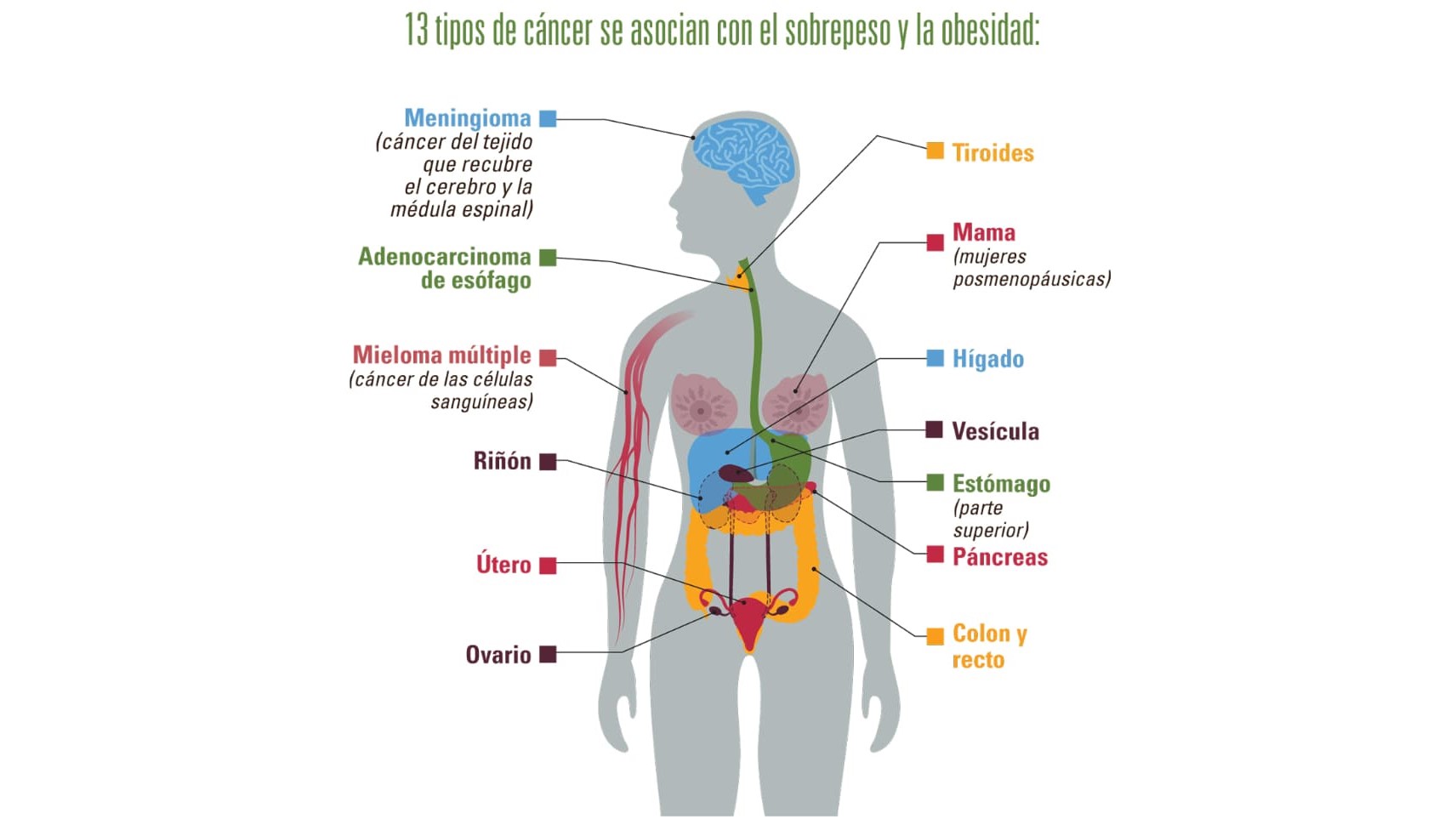 Obesity Cancer Spanish 13 tipos de cáncer se asocian con el sobrepeso y la obesidad: meningioma (cáncer del tejido que recubre el cerebro y la médula espinal); adenocarcinoma de esófago Mieloma múltiple (cáncer de las células sanguíneas); riñón; útero; ovario; tiroides; mama (mujeres posmenopáusicas); hígado; vesícula; estómago (parte superior); páncreas; y colon y recto.