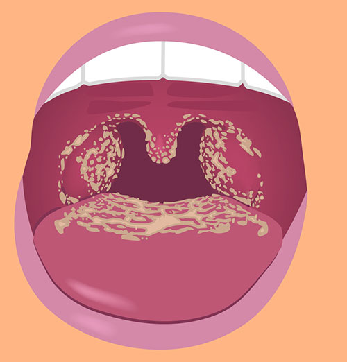 Open mouth with candidiasis infection Illustration of open mouth with white patches in the back of the tongue and throat
