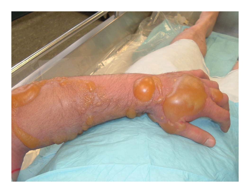 Blister Agent Exposure An image of a hand and forearm with burns and blisters from mustard exposure.