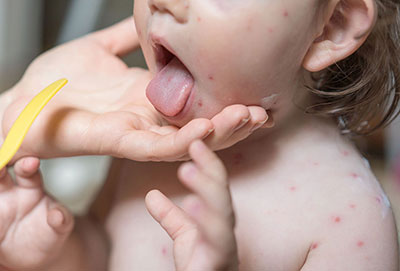 chickenpox-dotw-baby Toddler with chickenpox.