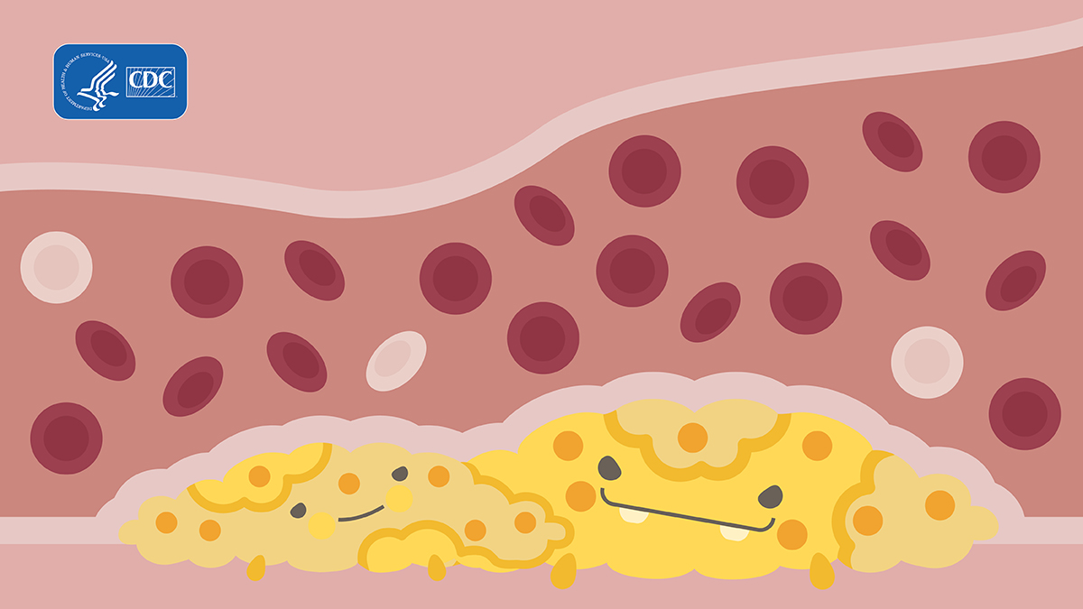 Cholesterol-Monster2 Two cholesterol monsters.