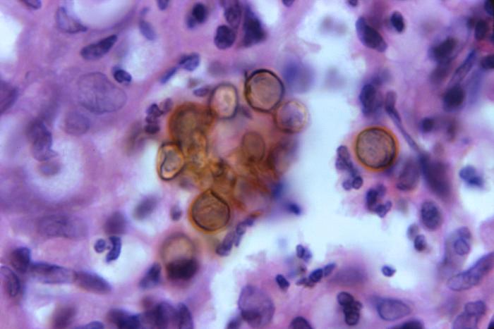 Characteristic pigmented fungal cells of chromoblastomycosis Characteristic pigmented fungal cells of chromoblastomycosis