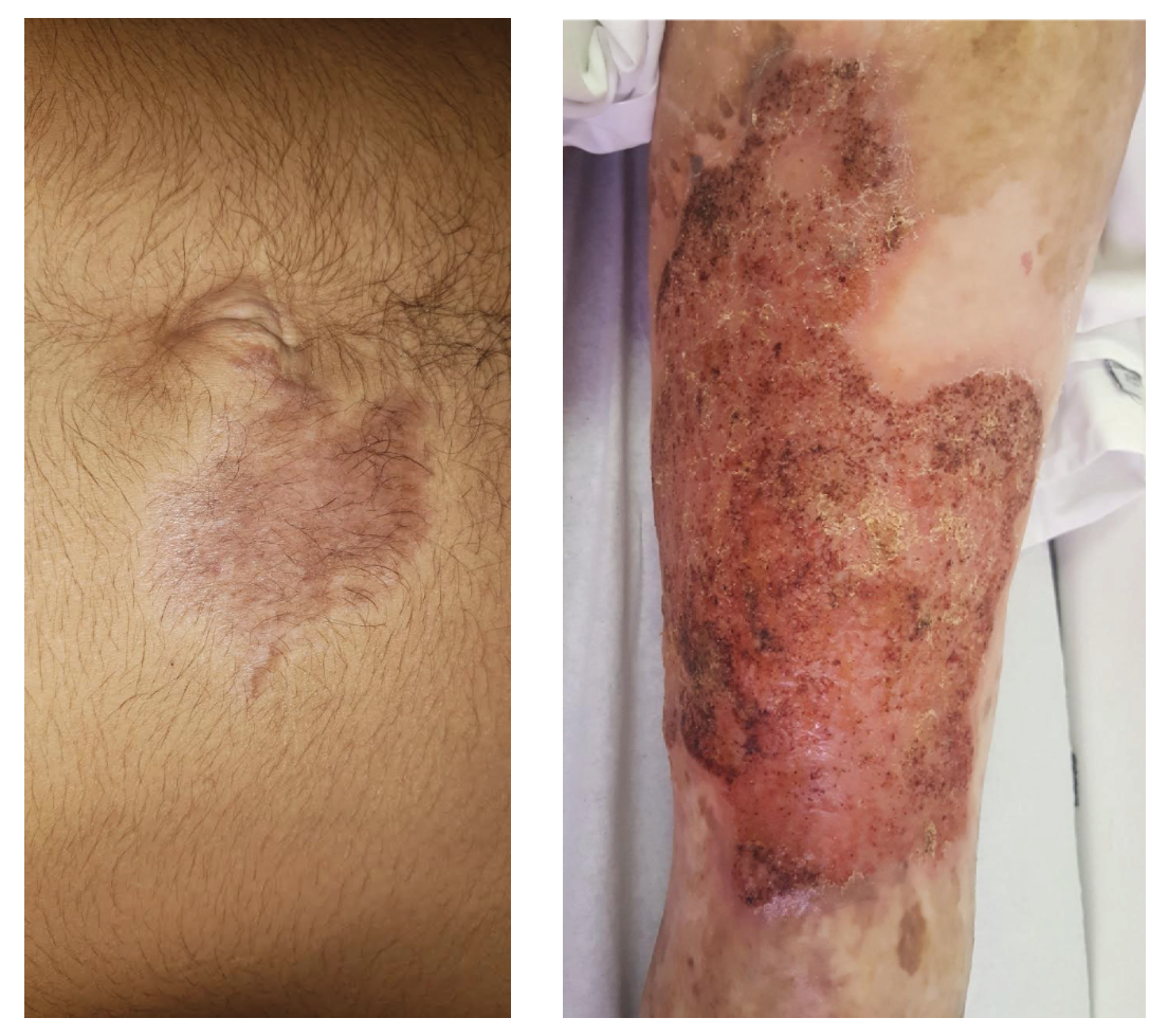Early and late stage of chromoblastomycosis infection. Photo credit to “Conceicão de Maria Pedrozo e Silva de Azevedo from Universidade Federal do Maranhão, Maranhão, Brazil” Early and late stage of chromoblastomycosis infection.