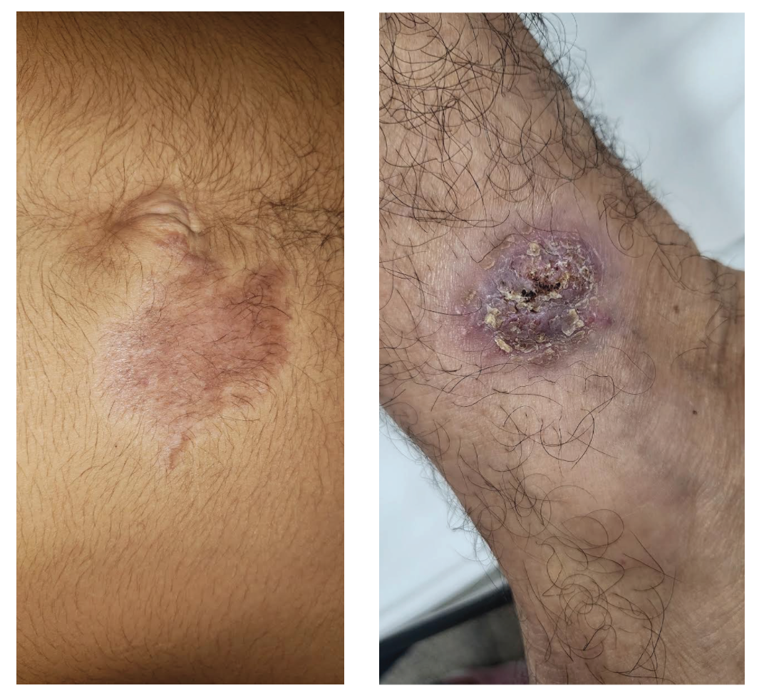 Early and late stage of chromoblastomycosis infection. Photo credit to “Conceicão de Maria Pedrozo e Silva de Azevedo from Universidade Federal do Maranhão, Maranhão, Brazil” Early and late stage of chromoblastomycosis infection.