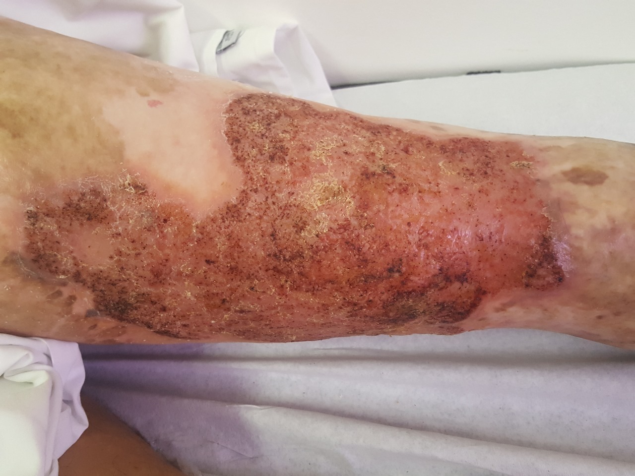 Gustavo's leg An image showing the impact of chromoblastomycosis on Gustavo's leg. The disease shows lesions and scars on his leg.
