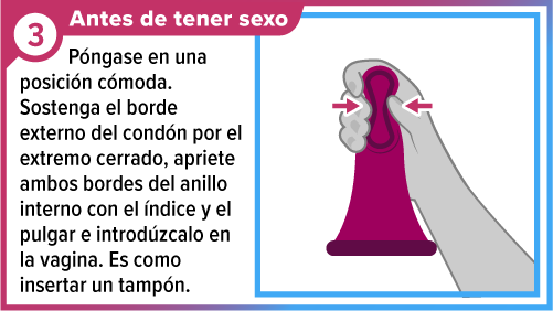 Female_condom_SPA-3 Una mano apretando el anillo grueso interno del condón femenino preparándolo para ser insertarlo.