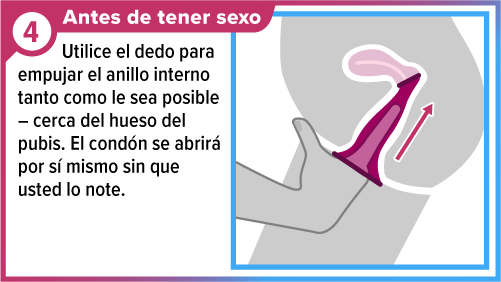 Female_condom_SPA-4 Dedo insertando el condón femenino dentro de la vagina.
