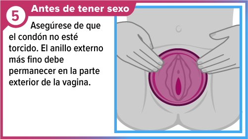 Female_condom_SPA-5 Un par de manos posicionando el condón femenino de manera que cubra la vulva.