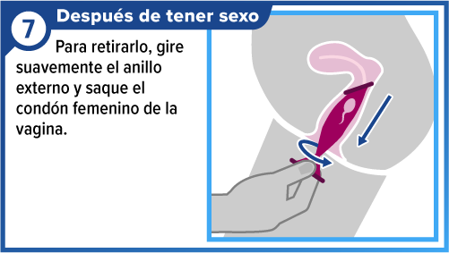 Female_condom_SPA-7 Mano retirando el condón femenino.