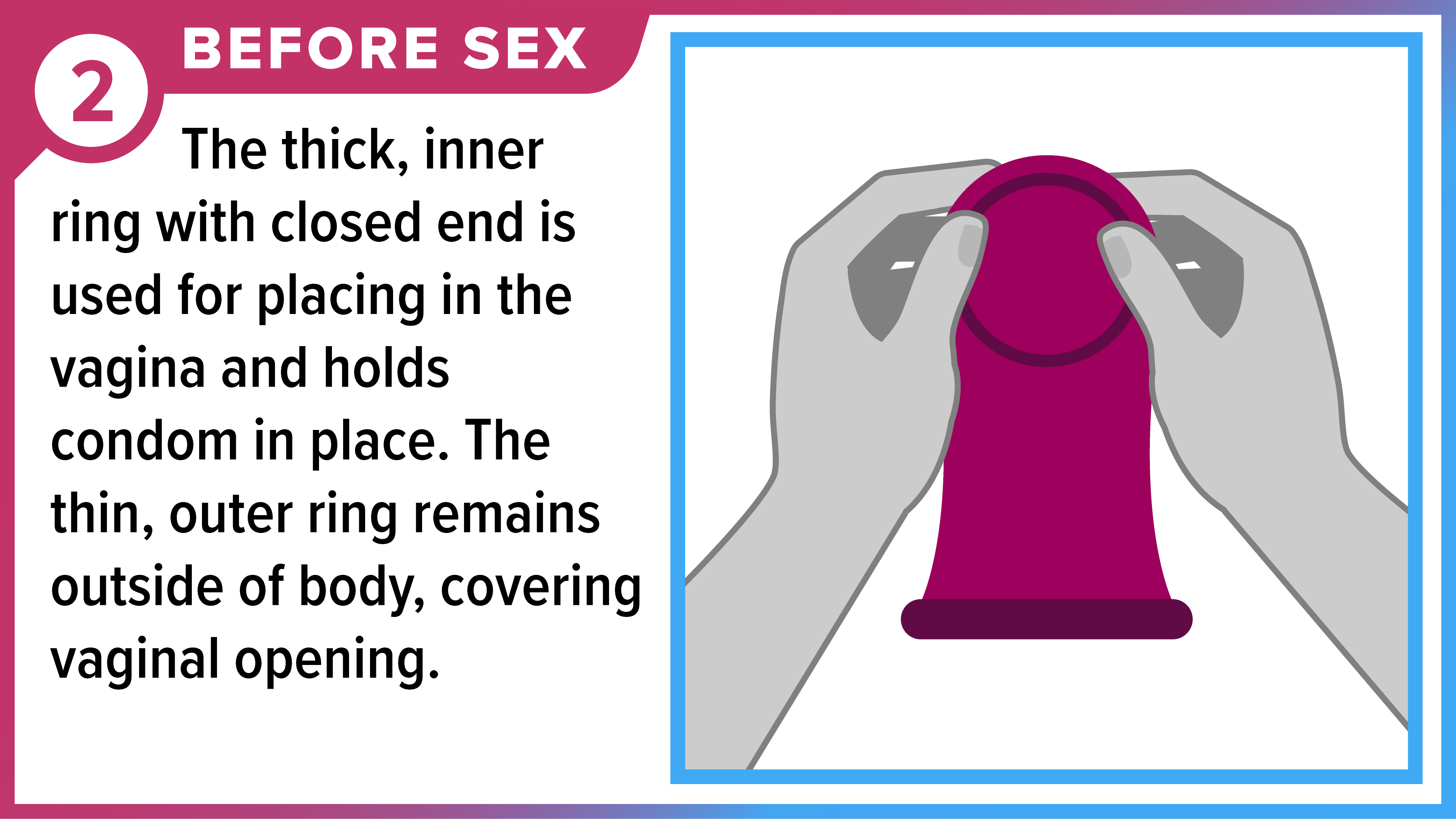 How to Use a Female (Internal) Condom Part 2 of 8 Hands holding female condom at the thick, inner ring. Before sex - The thick, inner ring with closed end is used for placing in the vagina and holds condom in place. The thin, outer ring remains outside of body, covering vaginal opening.