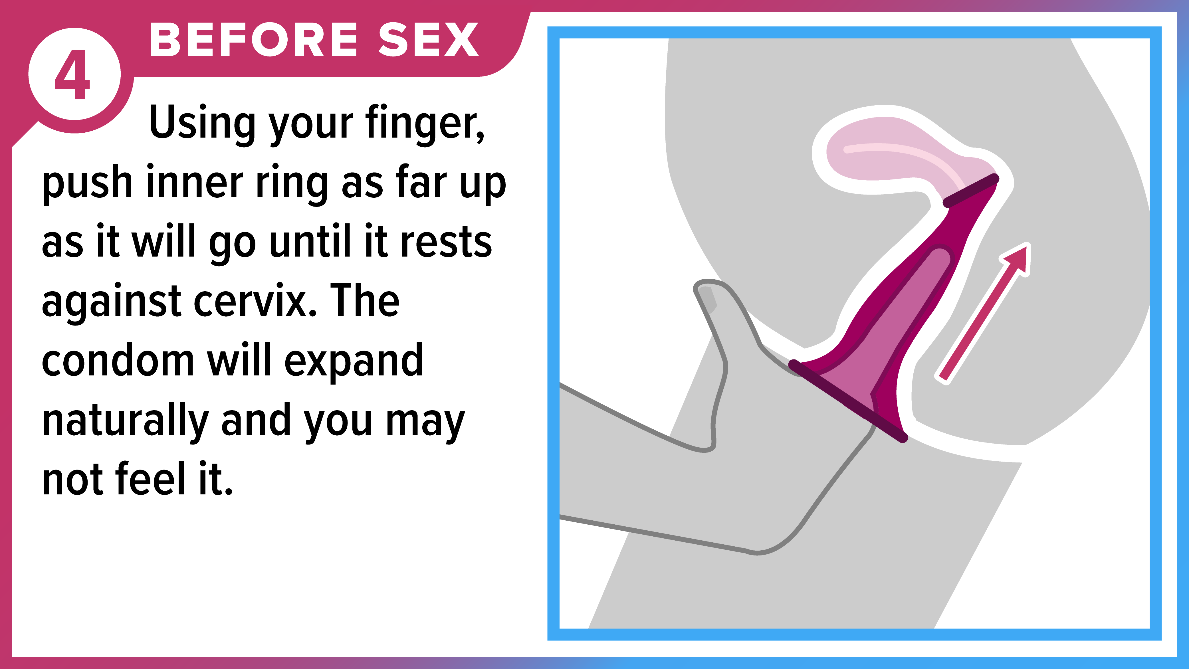 How to Use a Female (Internal) Condom Part 4 of 8 Finger inserting female condom into vagina. Before sex - Using your finger, push inner ring as far up as it will go until it rests against cervix. The condom will expand naturally, and you may not feel it.