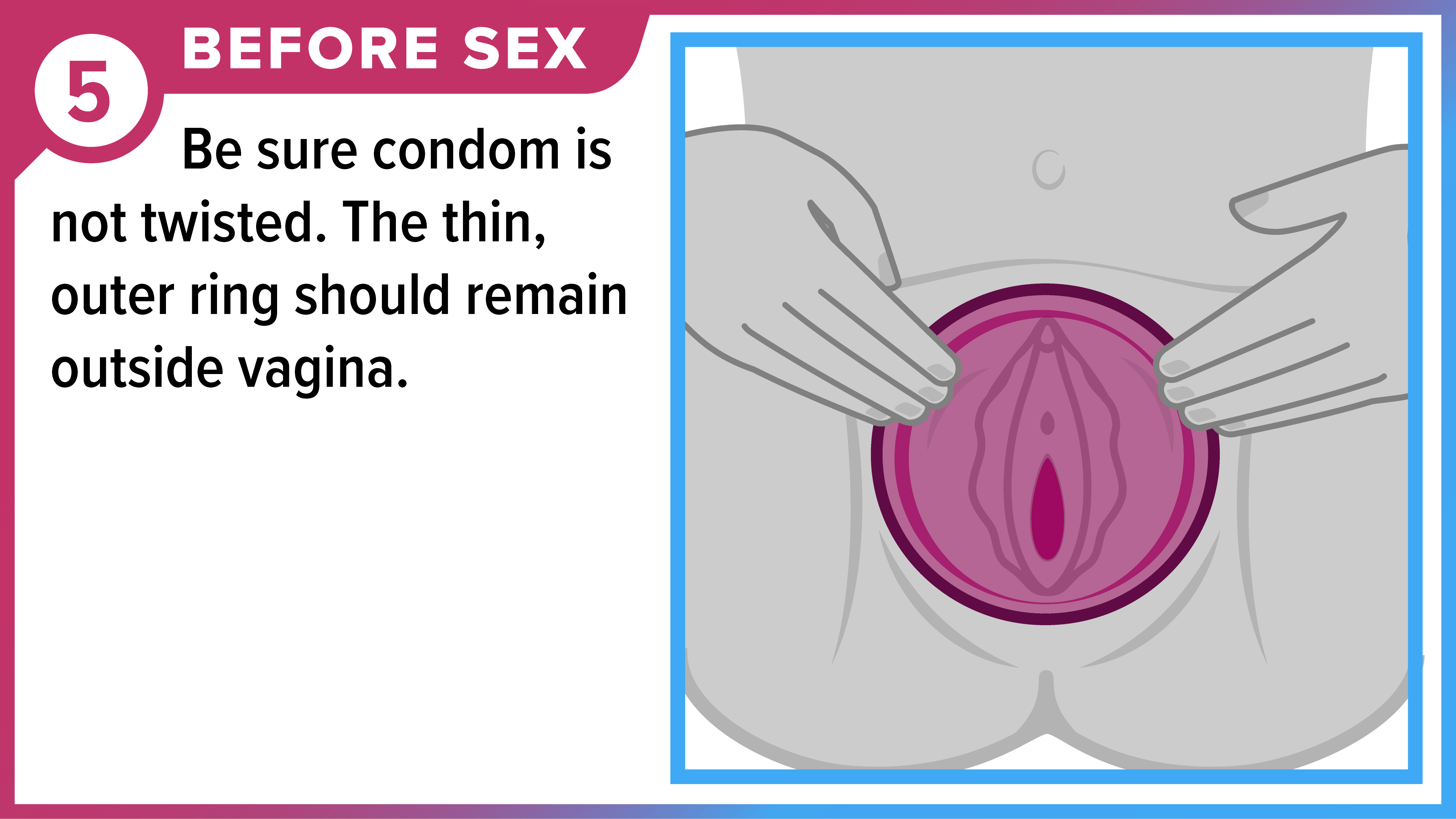 How to Use a Female (Internal) Condom Part 5 of 8 Hands positioning female condom in place to cover vulva. Before sex - Be sure condom is not twisted. The thin, outer ring should remain outside vagina.