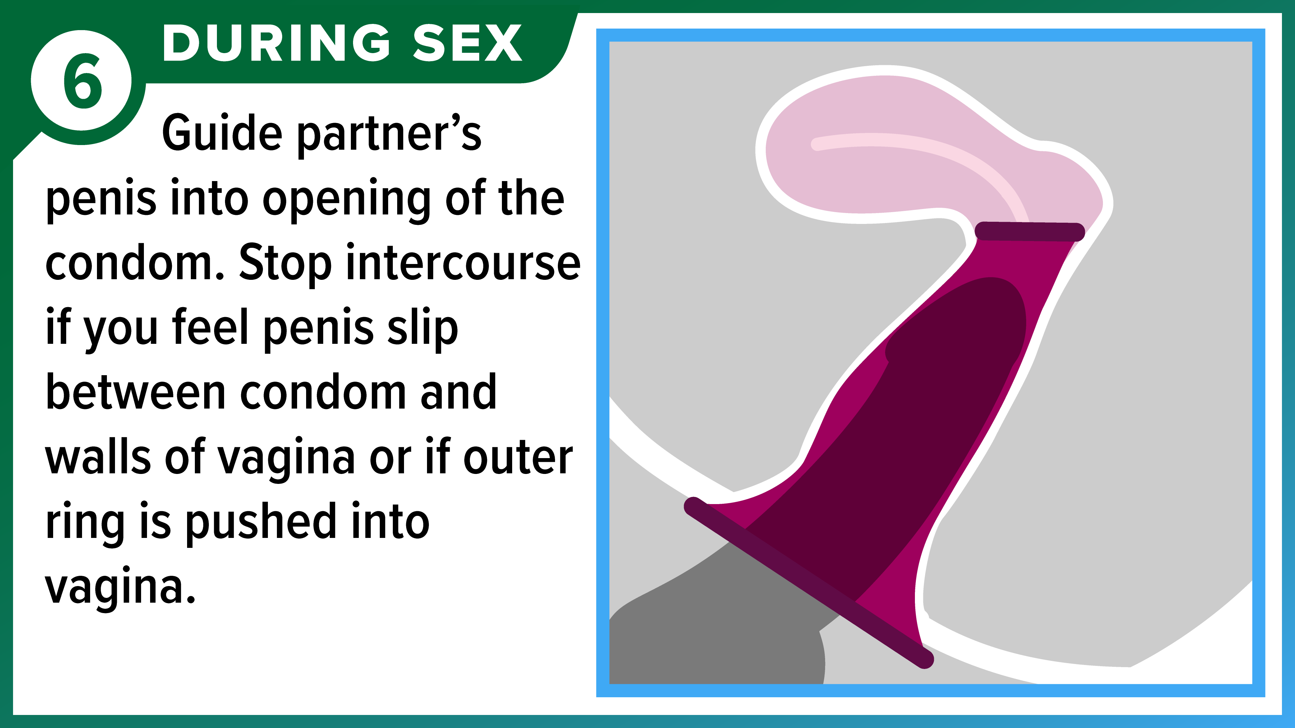 How to Use a Female (Internal) Condom Part 6 of 8 Female condom in place with penis inserted into vagina. During sex - Guide partner's penis into opening of the condom. Stop intercourse if you feel penis slip between condom and walls of vagina or if outer ring is pushed into vagina.