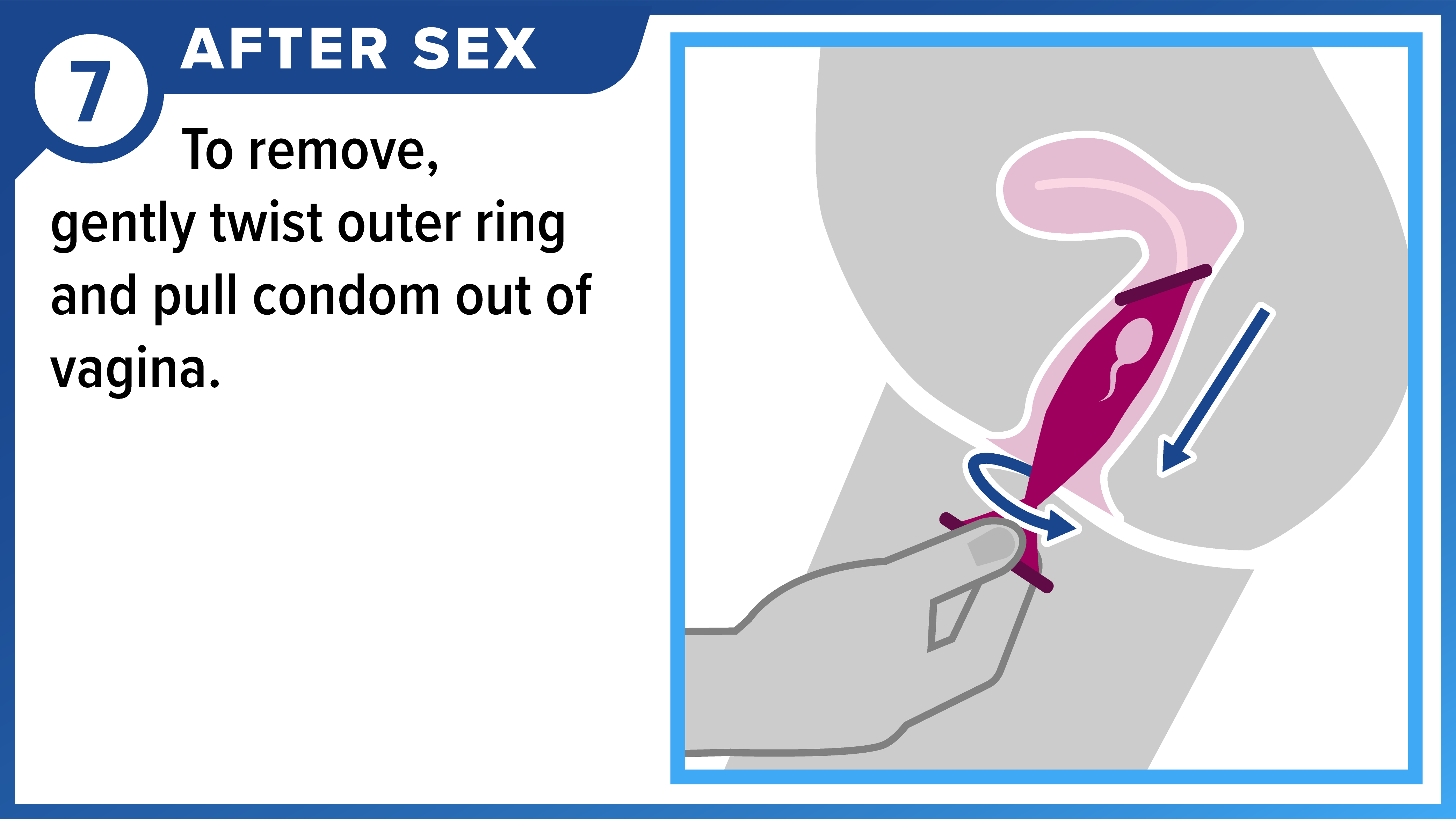 How to Use a Female (Internal) Condom Part 7 of 8 Hand removing female condom. After sex - To remove, gently twist outer ring and pull condom out of vagina.