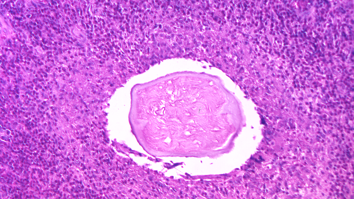 Dirofilaria Eye tissue specimen showing Dirofilaria sp. nematode, or roundworm, magnified.