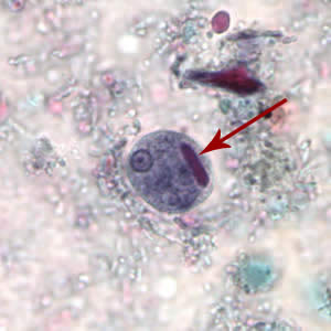 Ehistdisp_cyst_tric.jpg