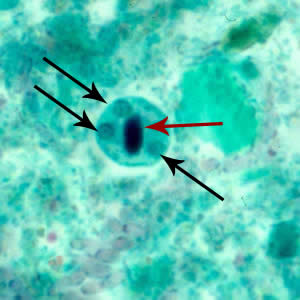 Ehistdisp_cyst_tric2.jpg