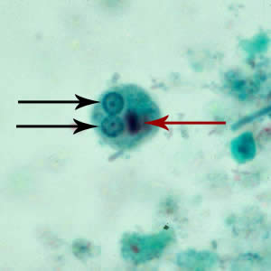 Ehistdisp_cyst_tric3.jpg