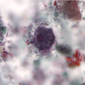 Ehistdisp_cyst_tric4.jpg