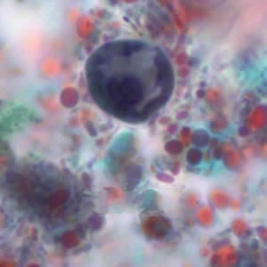 Ehistdisp_cyst_tric5_KS.jpg
