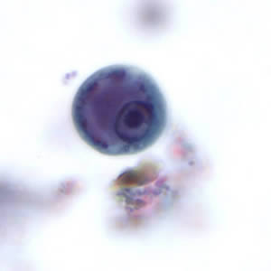 Ehisto_cyst_tric.jpg