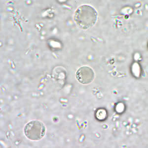Bhominis_cyst_wtmt.jpg Figure A